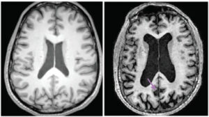 Alzheimer agy